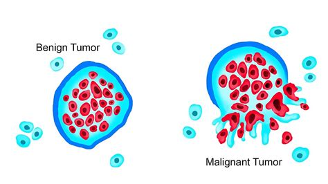 Tumors and cancer