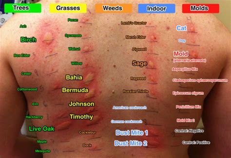 Types of allergy skin tests