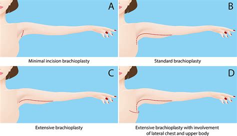 Types of Arm Implants