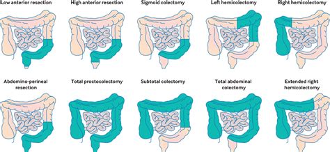 types of colon resection surgery
