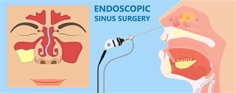 types of endoscopic sinus surgery procedures