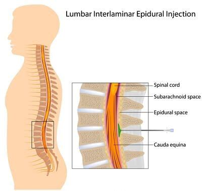 Types of Epidural Injections
