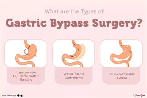 Types of gastric bypass surgery