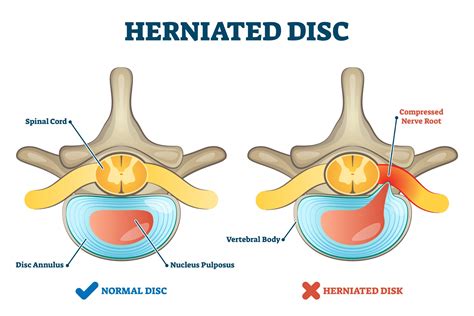 Types of Herniated Disc Surgery