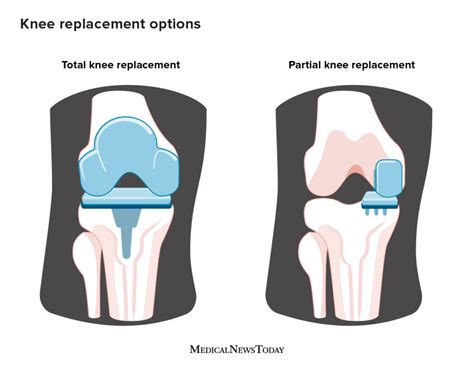 Types of Knee Transplant Surgery