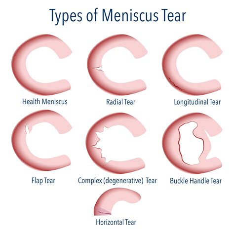 Types of Meniscus Tear Surgery