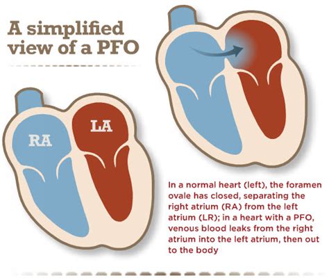 Types of PFO