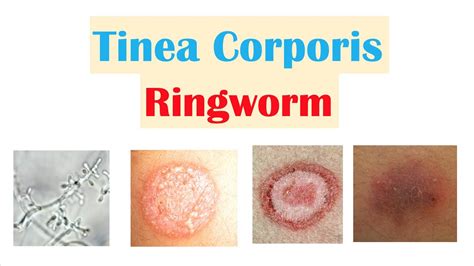types of ringworm