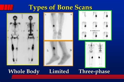 Types of Bone Scan Image