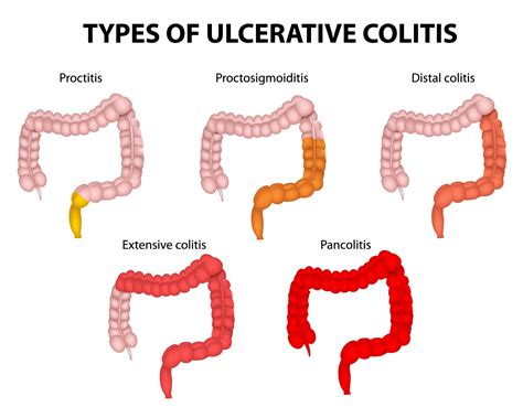 Ulcerative Colitis Surgery