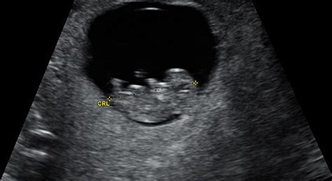 ultrasound dating