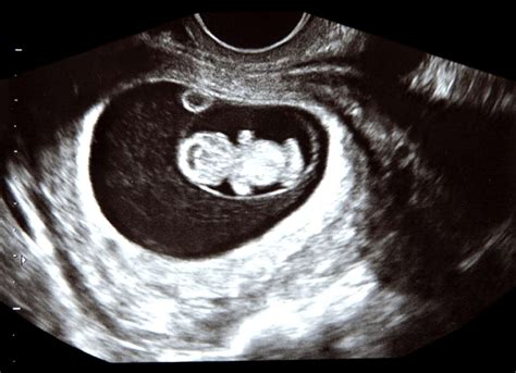 Ultrasound Scan At 9 Weeks