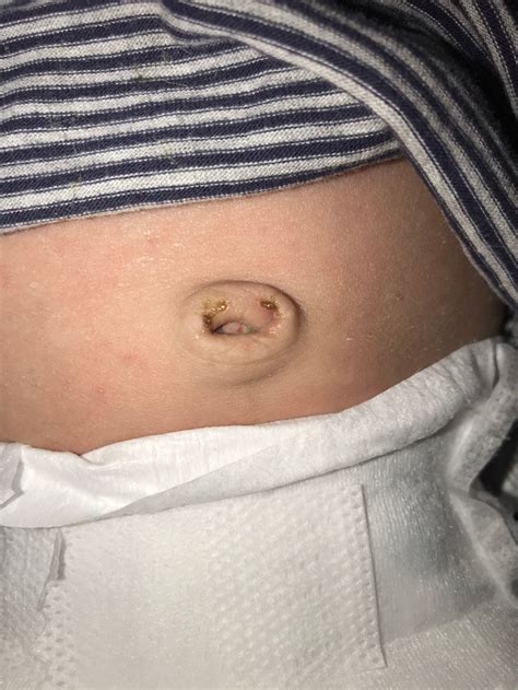 Umbilical Cord Stump