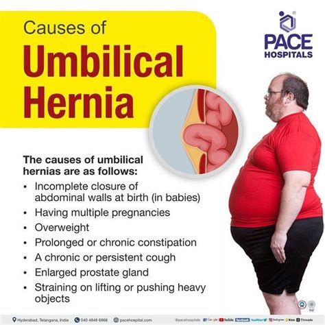 Umbilical Hernia Causes