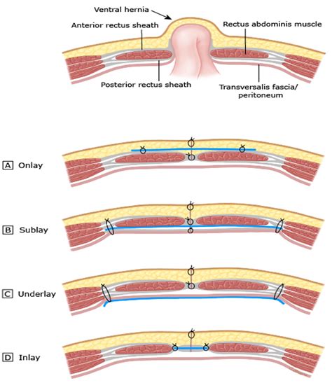 Umbilical Hernioplasty