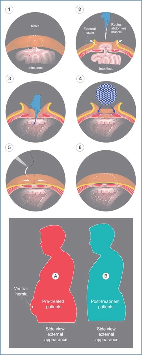 Umbilical Hernioplasty Procedure