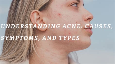 Understanding Acne