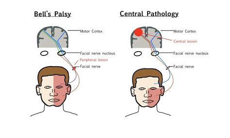 Understanding Bell's Palsy