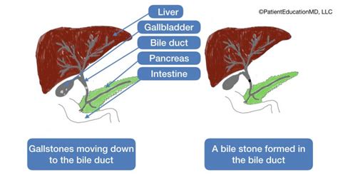 Understanding Bile Stones
