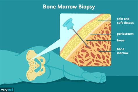 understanding bone marrow biopsy results