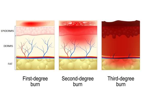 Understanding Burn Injuries
