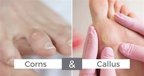 Understanding Callus