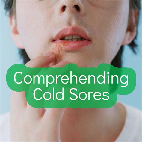 Understanding Cold Sores