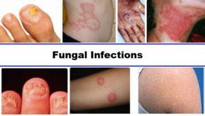 Understanding Fungal Infections
