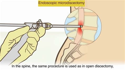 Understanding Herniated Disc Surgery