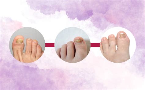 Understanding Ingrown Nails