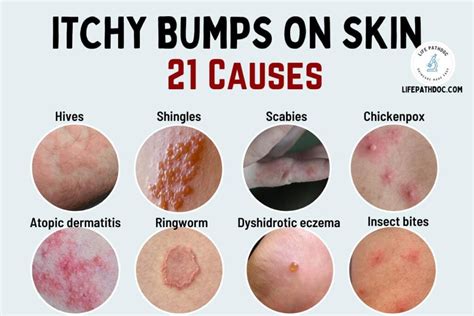 Understanding Itching