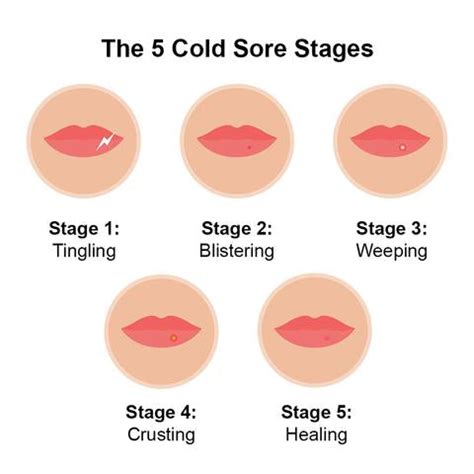 Understanding Lip Cold Sores
