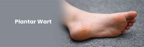 Understanding Plantar Warts