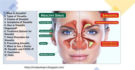 Understanding Sinusitis