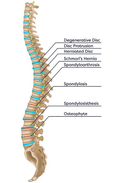 Understanding Spinal Conditions
