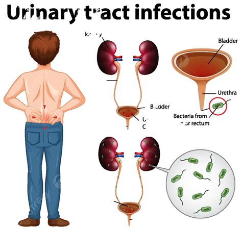 Understanding Urine Pain