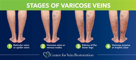 Understanding Varicose Veins