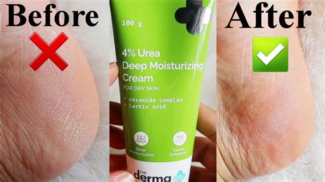 Urea Cream for Sensitive Skin