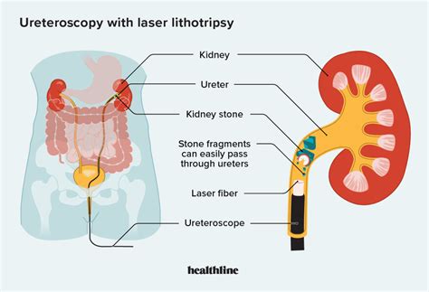 ureteroscopy
