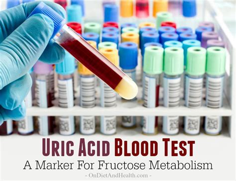Uric Acid Blood Test