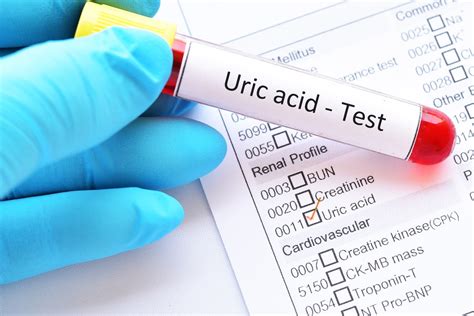 Uric Acid Blood Test Results