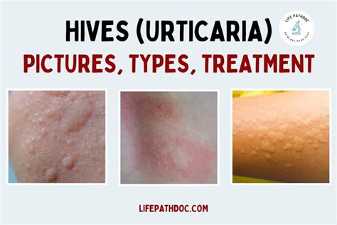urticaria symptoms