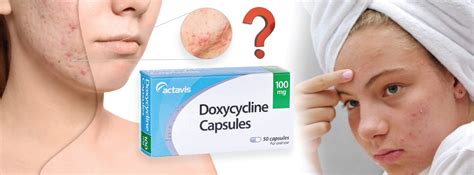 Uses of Doxycycline