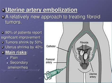 Uterine Artery Embolization Conclusion