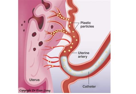Uterine Artery Embolization Recovery