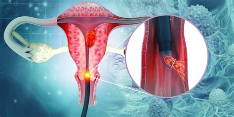 Uterine Lining Biopsy Risks