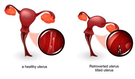 Uterus and Fertility