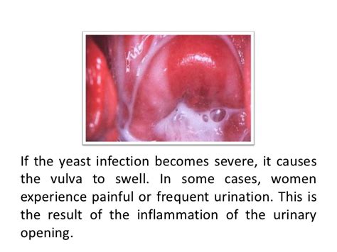 Vaginal Yeast Infection Complications