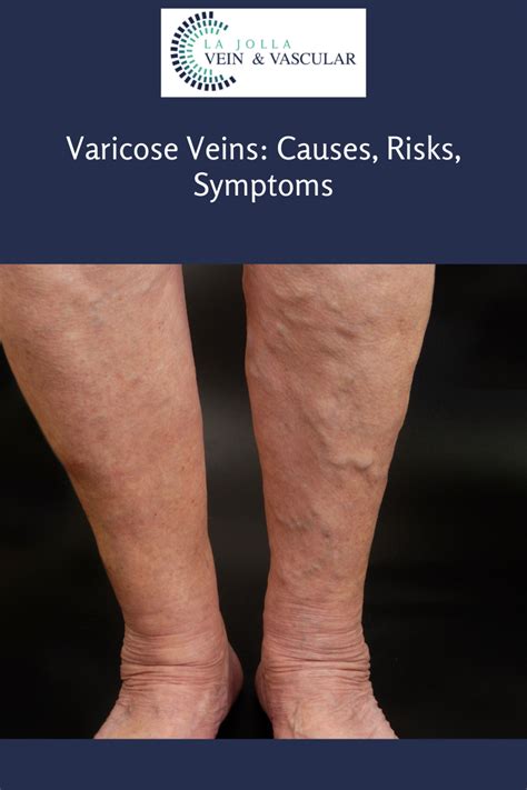 Varicose Veins Causes