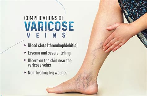 Varicose Veins Complications